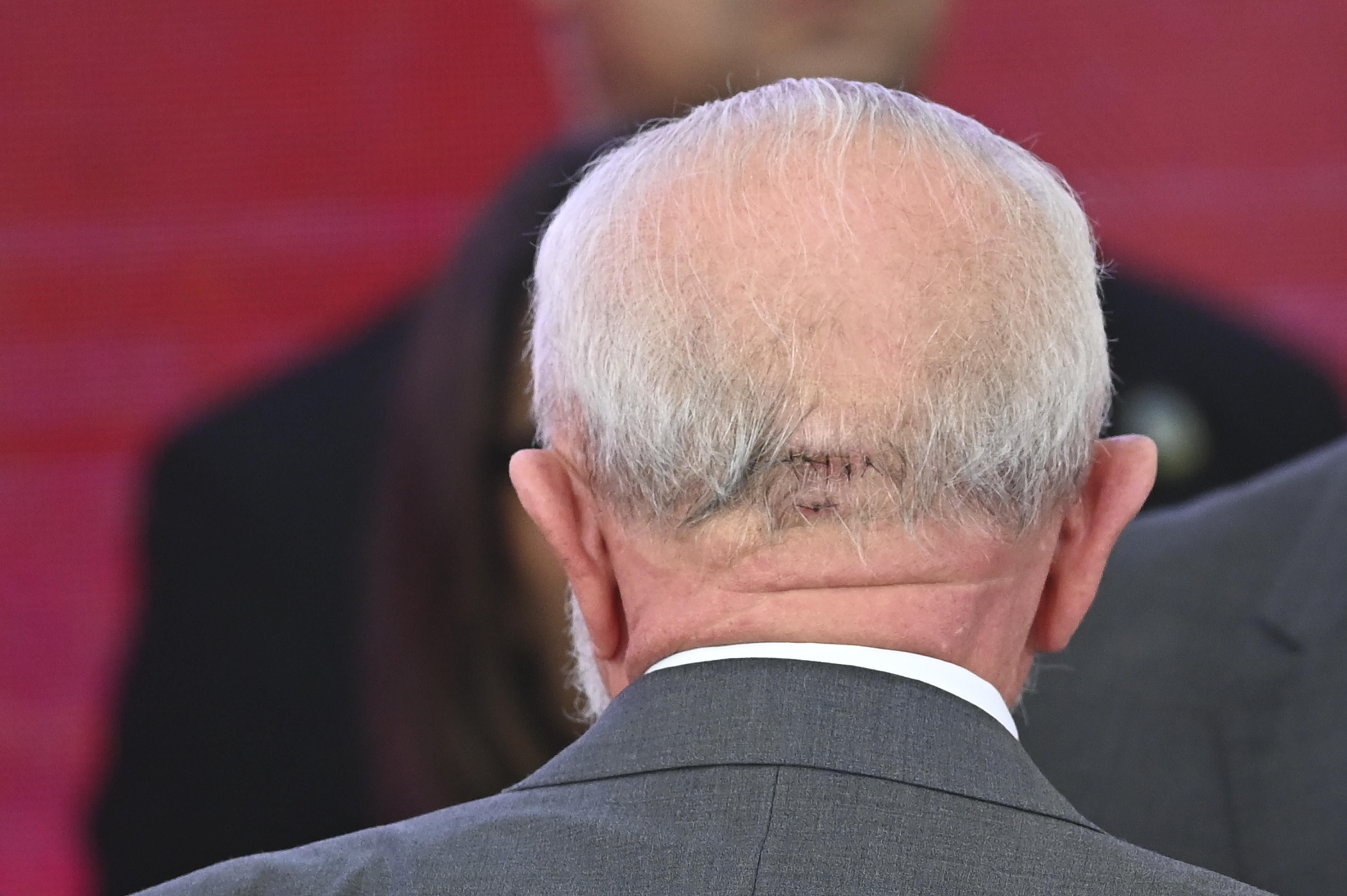 Lula é submetido a cirurgia emergencial após hemorragia cerebral