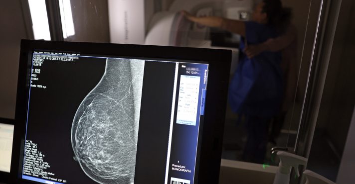 Entidades Médicas Solicitam à ANS Rastreio de Câncer de Mama para Mulheres Abaixo de 50 Anos