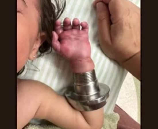 Bebê sofre acidente grave após braço ser sugado por tubulação de piscina em SP.